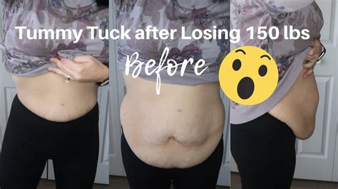 nude gastric sleeve and tummy tuck